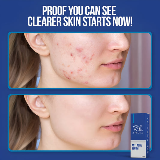 Viki Special Anti Acne Serum – 30ml